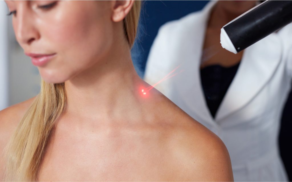 laserbehandlung